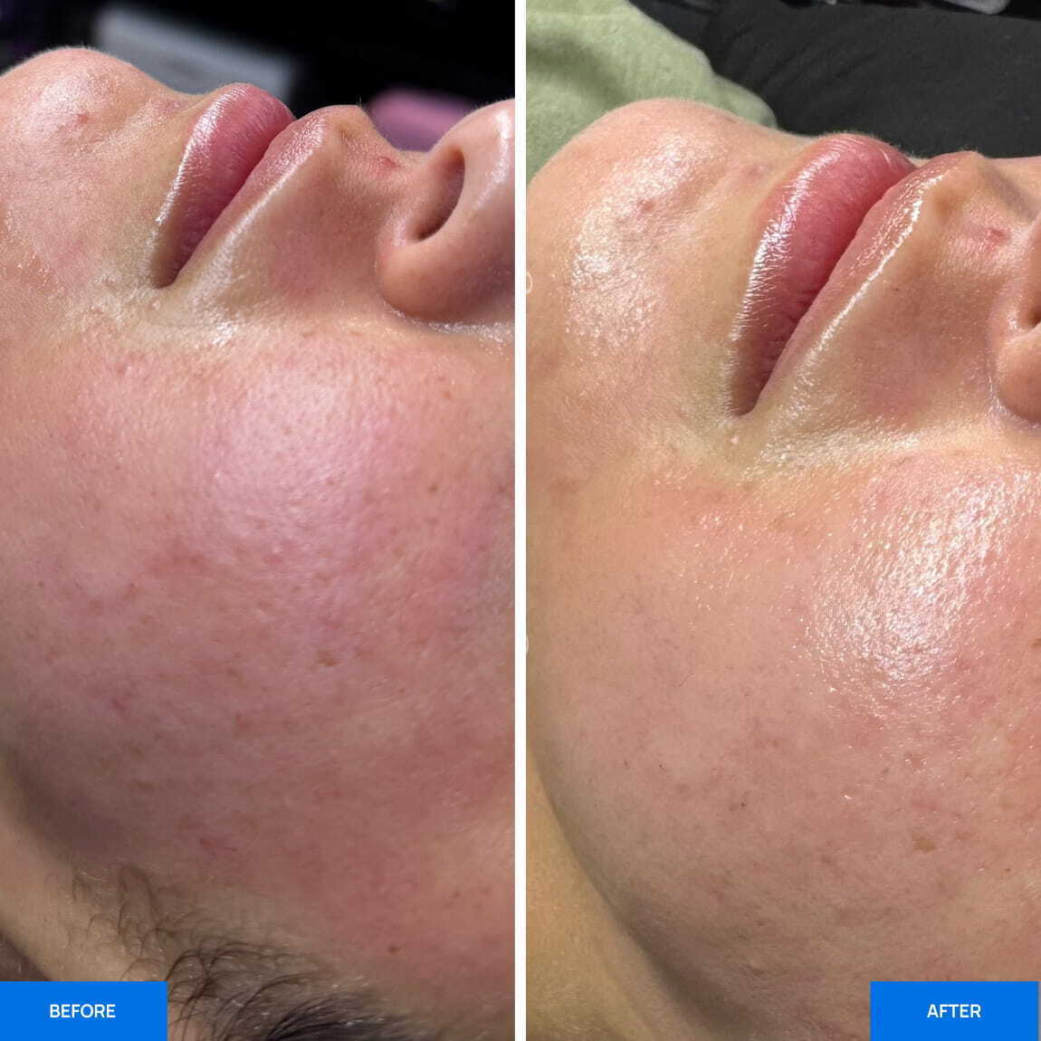 Zemits OxiVelour Pro