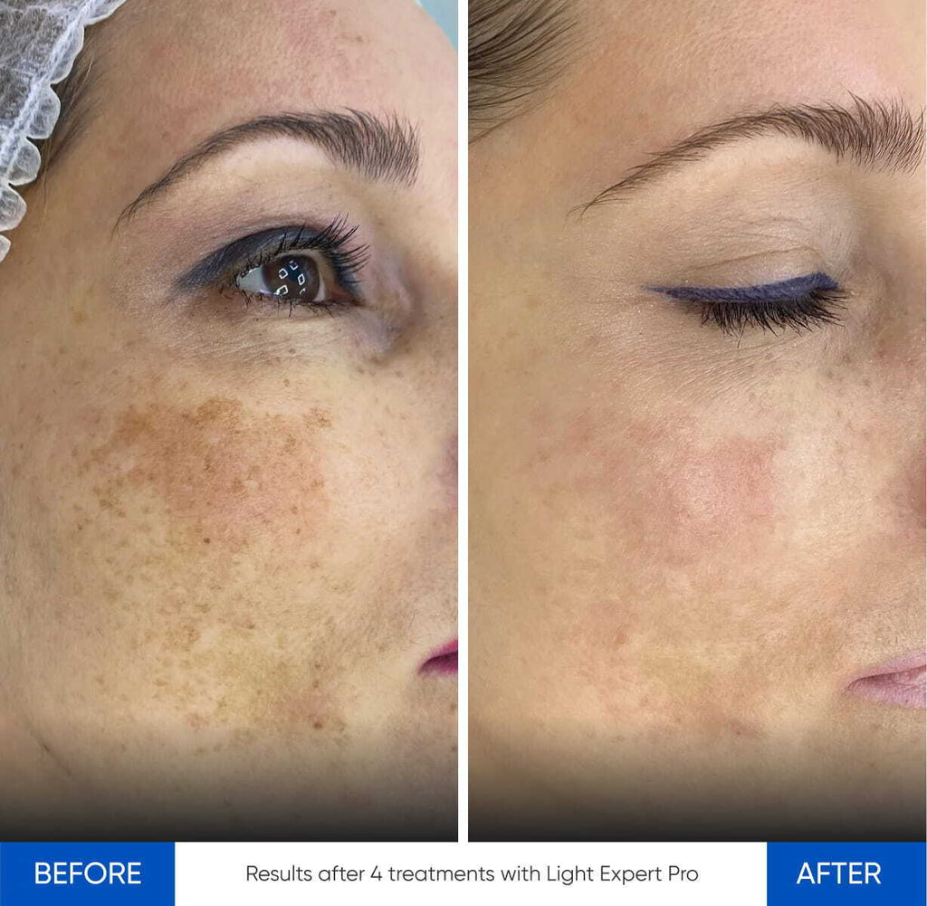 Zemits Light Expert Pro