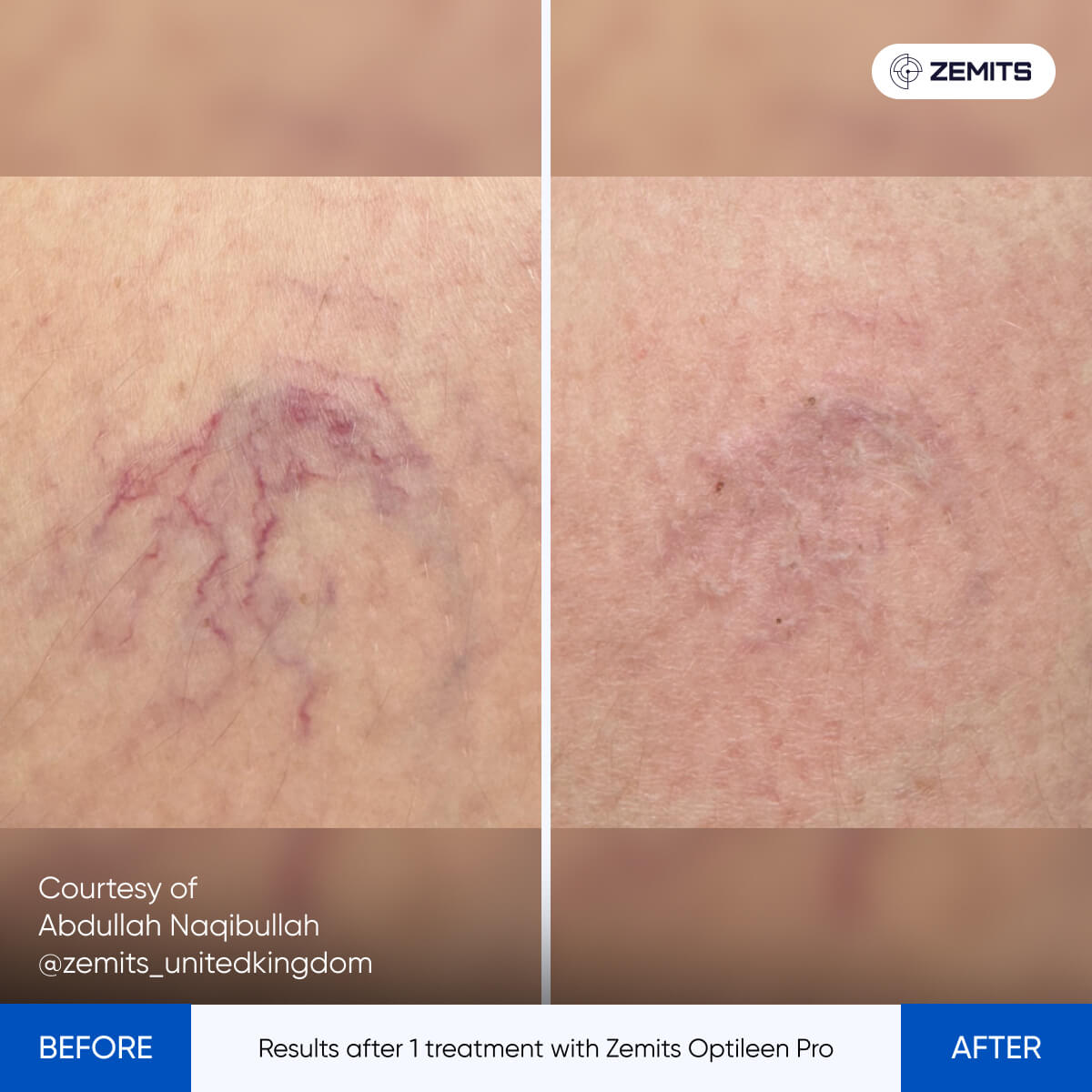 Zemits OptiLeen Pro