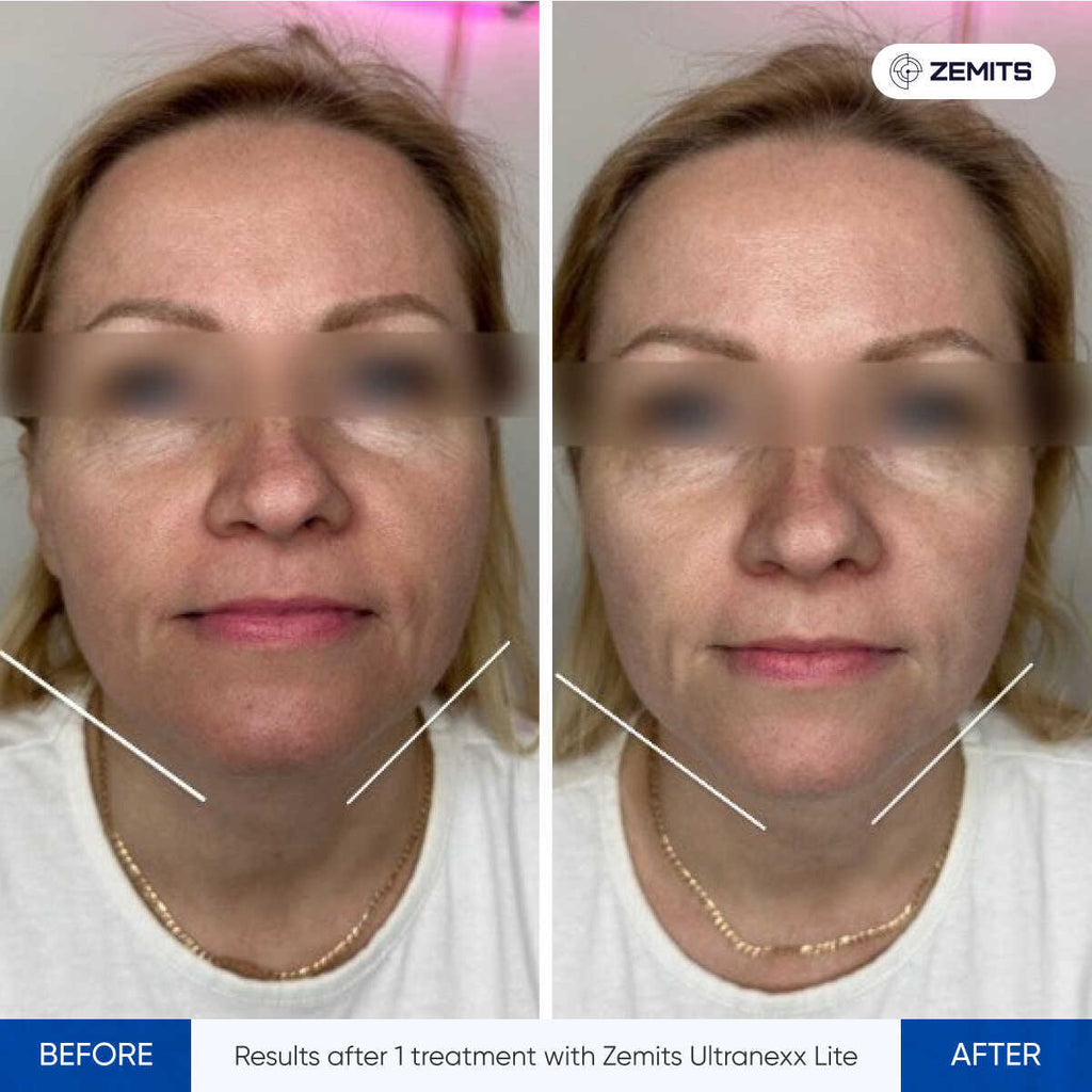 Zemits UltraNexx Lite