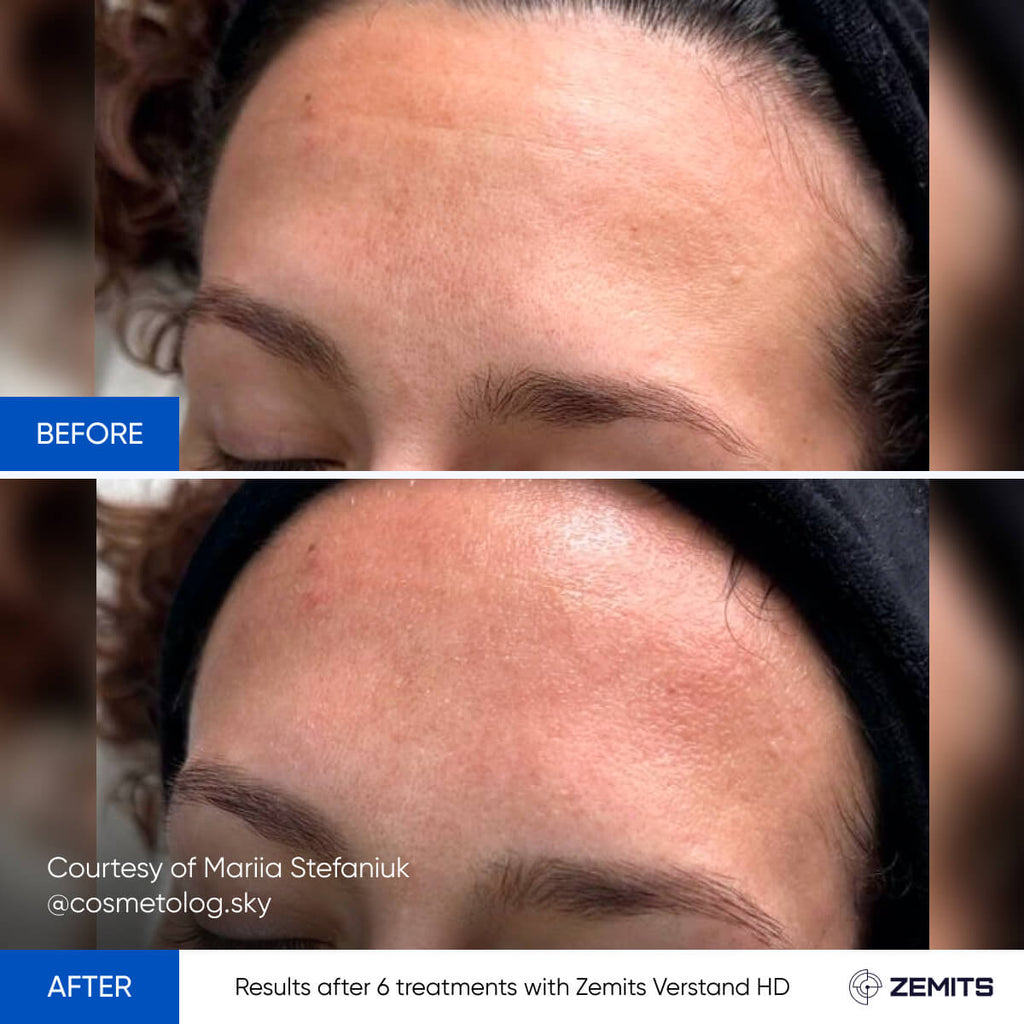 Zemits Verstand HD PRO