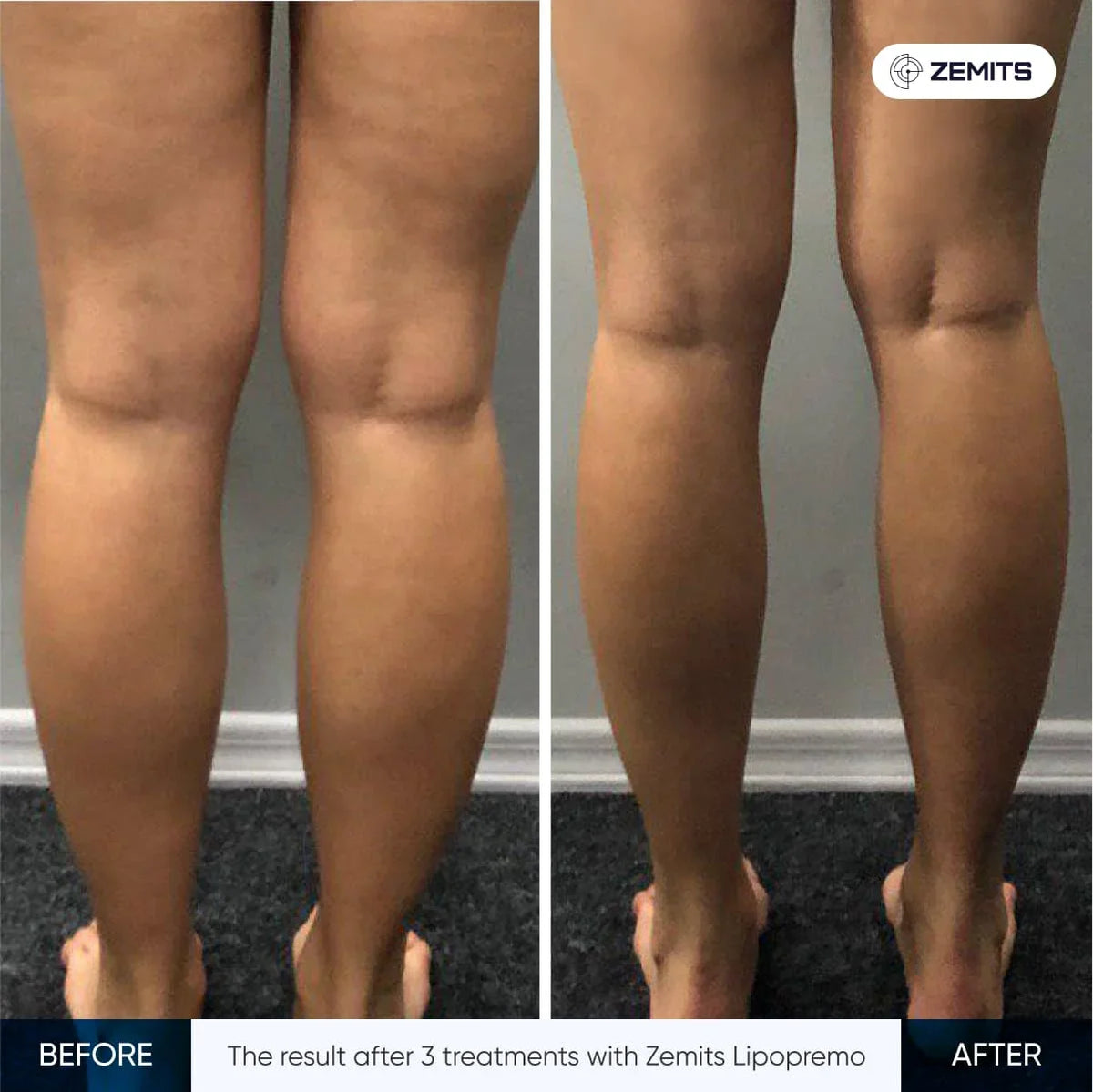 Zemits LipoPremo